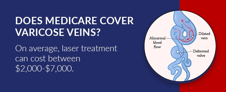 Varicose veins Medicare coverage
