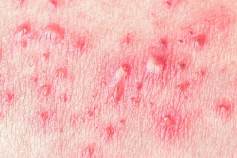 Complications of Shingles in the Elderly